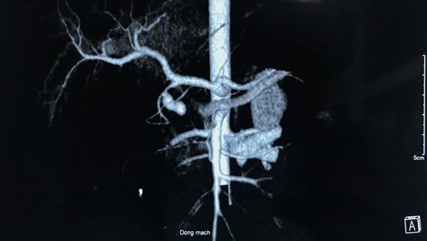 Hình chụp X-Quang phổi của bệnh nhi